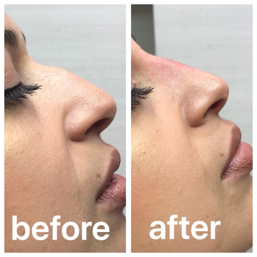 Rhinoplasty result KOQ10